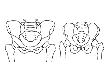 Ábra: Felnőtt csípője (a combcsont feje alig látszik ki a medencecsont kimélyüléséből) és újszülött csípője (a combcsont fejéből jóval több látszik)